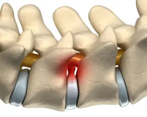 Deu no exame – Protusão Discal