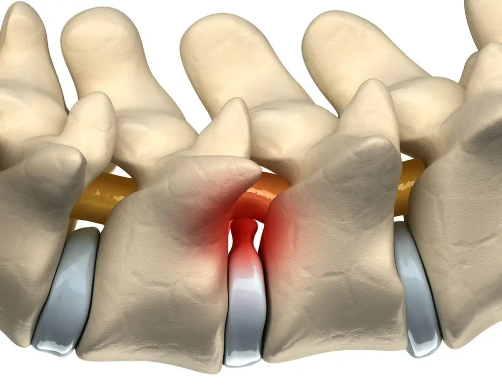 Deu no laudo - Protusão Discal