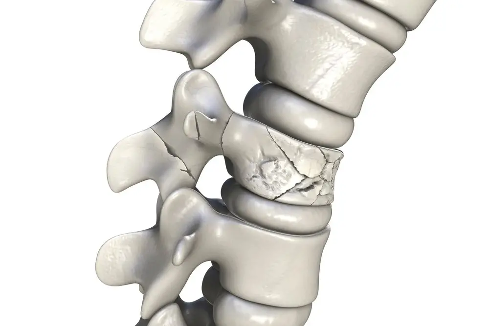 Quais São as Lesões da Coluna Vertebral? Conheça as Principais Patologias e Como Prevenir